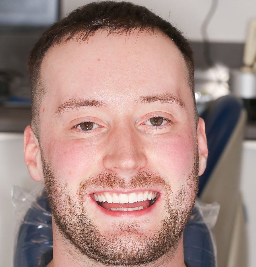 Edge Bonding After - 3dental